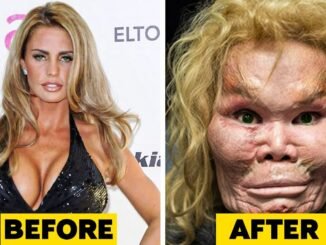 Model Removes Fillers After Near-Death Ordeal