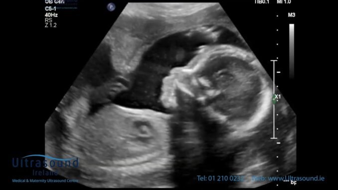 Woman alters pregnancy scan date