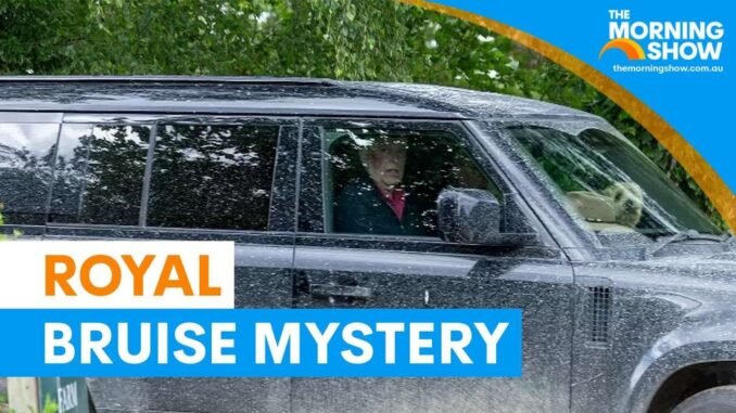 Andrew's Facial Bruise Leaves Public Asking Questions