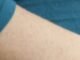 Debate sparks over US pregnancy treatment